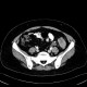 Carcinoma of sigmoid colon, metastasis of liver: CT - Computed tomography